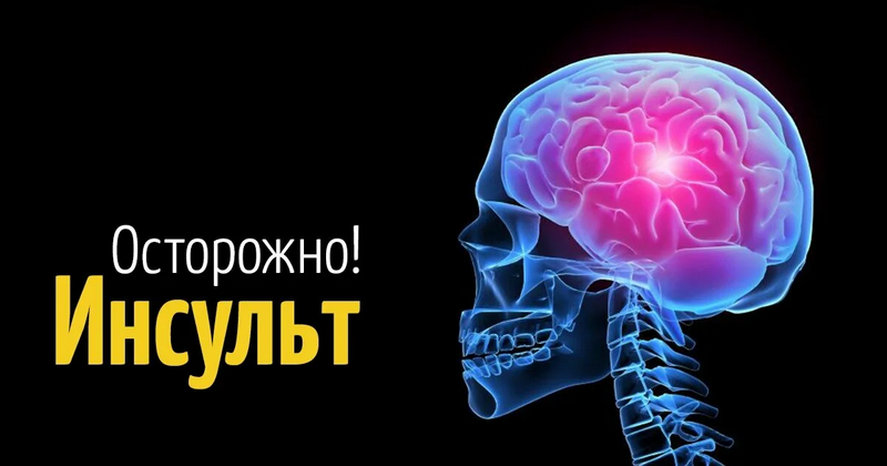 Чтобы избежать инсульта – советы от врача-невролога Кировской ЦРБ