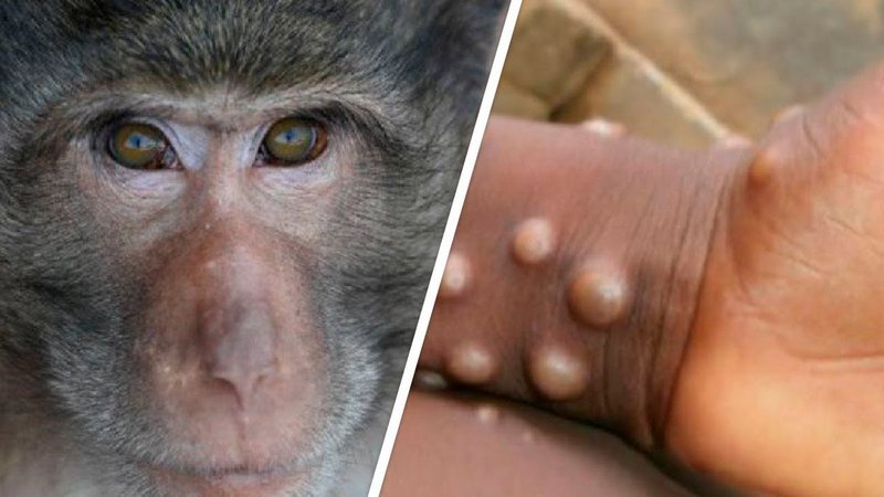 Что нужно знать об оспе обезьян? – разъясняет врач Кировского райЦГЭ